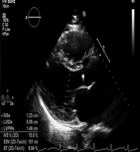 severely reduced left ventricular function.